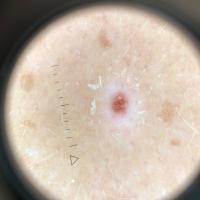 Dermoscopic appearance of the previous figure
