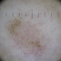 Dermoscopic appearance of the same patient - the…