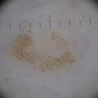 Dermoscopic appearance of previous figure - the…