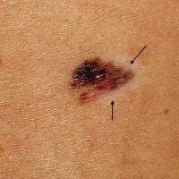 
	A melanoma undergoing regression
	
	Although…
