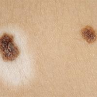 
	Halo naevus close-up 
	
	The lesion on the…