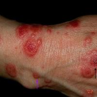 
	Erythema multiforme secondary to herpes…