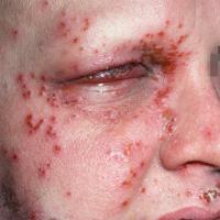 
	Eczema herpeticum&nbsp;