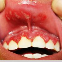 
	Herpetic gingivostomatitis
