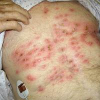 
	Disseminated herpes simplex in a patient on…