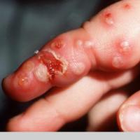 
	Herpetic whitlow