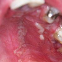 
	Herpetic gingivostomatitis