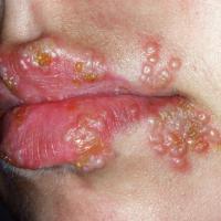 
	Herpes labialis&nbsp;