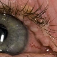 
	Herpes simplex on the upper eyelid