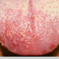 
	Herpetic gingivostomatitis