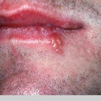 
	Herpes labialis