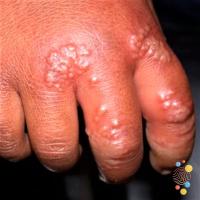 Herpes simplex&nbsp;
Copied with kind permission…