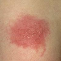 
	Herpes simplex&nbsp;on the sacral skin&nbsp;