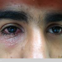 
	Herpes simplex around the eye