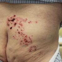 
	Herpes zoster