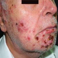 
	Herpes zoster

	Copied with kind permission…