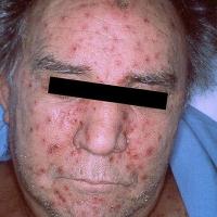 
	Disseminated herpes zoster in a patient with…