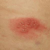 
	Herpes zoster

	Copied with kind permission…