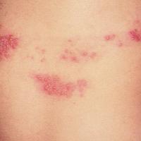
	Herpes zoster

	Copied with kind permission…