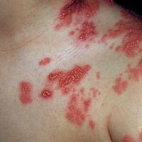 
	Herpes zoster - dermatomal distribution…