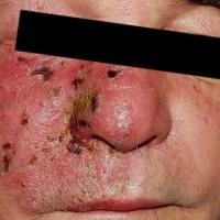 
	Herpes zoster affecting the eye

	Urgent…