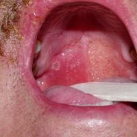 
	Herpes zoster in the mouth - dermatomal…