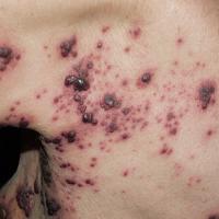 
	Herpes zoster

	Necrotic changes