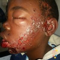 Herpes zoster
Copied with kind permission from…