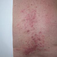 
	Herpes zoster - bilateral