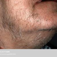
	Hirsutism in an elderly woman
	
	The pattern of…