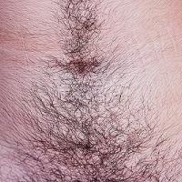 
	Hirsutism 
	
	Copied with kind permission from…