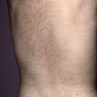 
	Hypertrichosis

	Non-terminal (vellus), soft…
