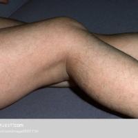 
	Hypertrichosis

	Non-terminal (vellus), soft…