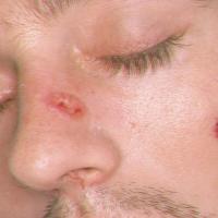 
	Cryptococcal infection associated with…