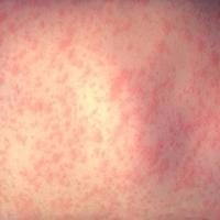 
	HIV seroconversion 