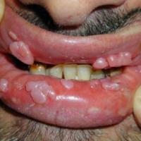 
	Viral warts associated with HIV