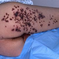 
	Herpes Zoster associated with HIV