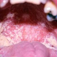 
	Oropharyngeal candida associated with HIV
