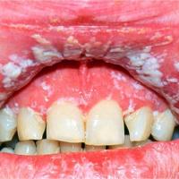 
	Oral candida associated with HIV

	&nbsp;