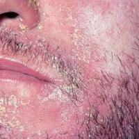 
	Seborrhoeic eczema associated with HIV