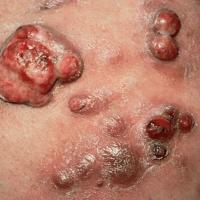 
	Bacillary angiomatosis associated with HIV
