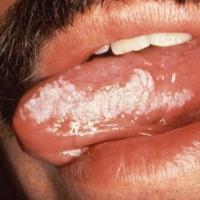 
	Oral hairy leukoplakia associated with HIV