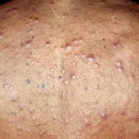 
	Eosinophilic folliculitis associated with HIV