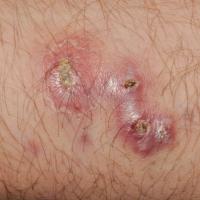 
	Atypical mycobacterial infection

	Copied with…