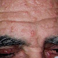 
	Molluscum contagiosum associated with…