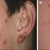 
	Hydroa vacciniforme