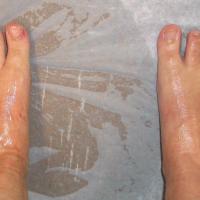 
	Primary hyperhidrosis of the feet