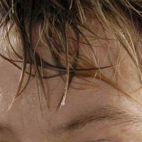 
	Primary hyperhidrosis of the face and head
