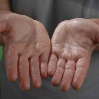 
	Primary hyperhidrosis of the palms