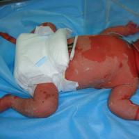 
	Epidermolytic ichthyosis